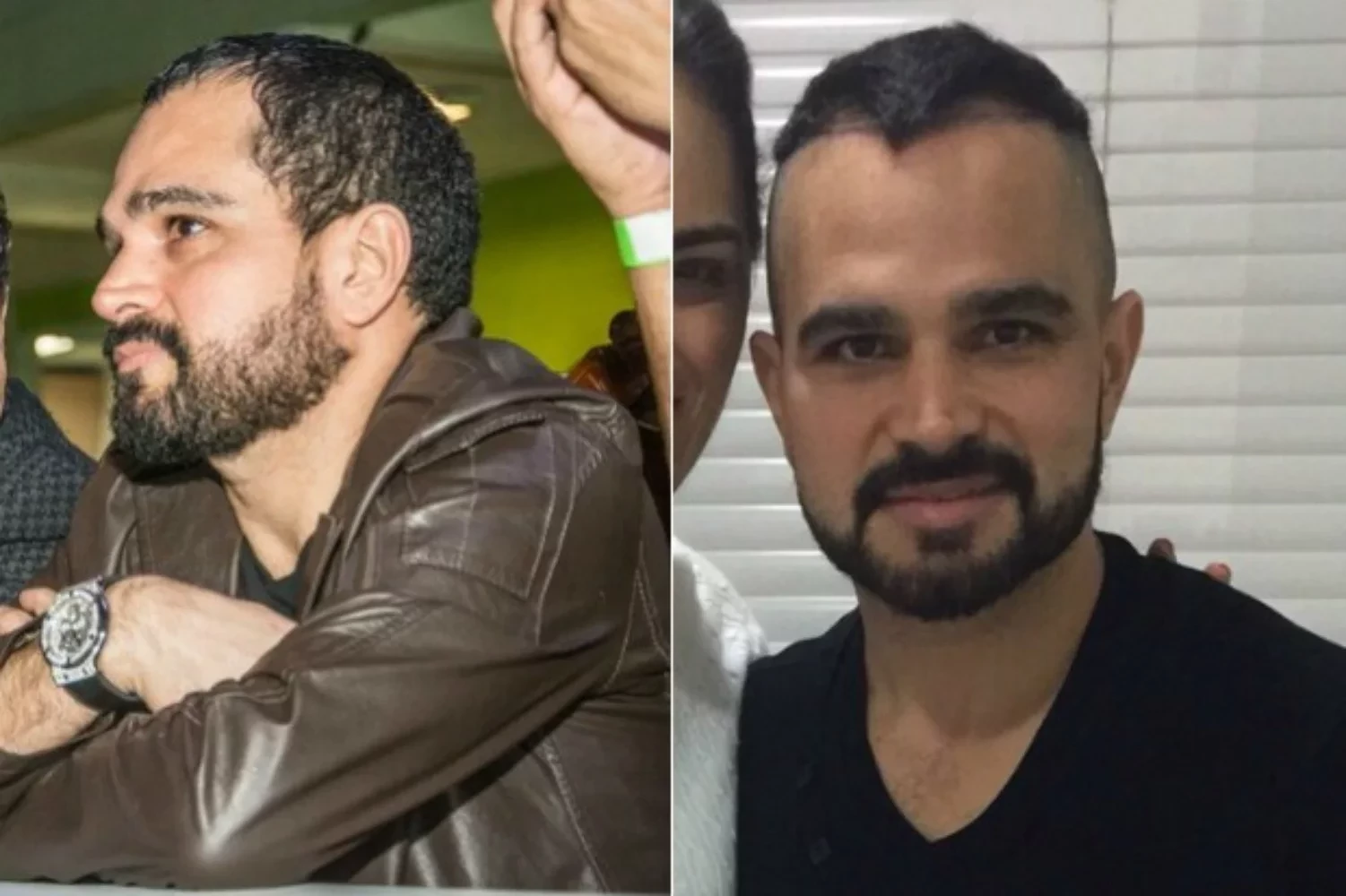 Saiba 10 famosos que fizeram implante de cabelo e se surpreenda - imagem 102075