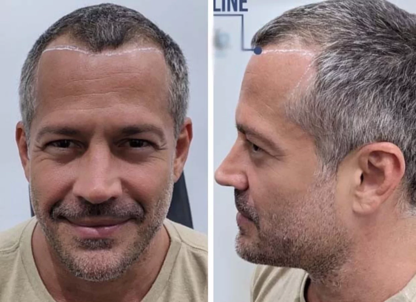 Saiba 10 famosos que fizeram implante de cabelo e se surpreenda - imagem 102078