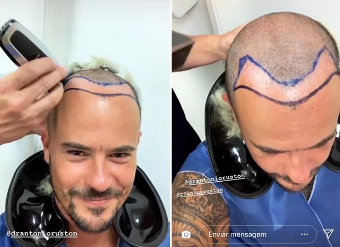 Saiba 10 famosos que fizeram implante de cabelo e se surpreenda - imagem 102077