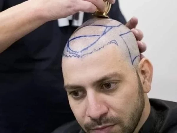 Saiba 10 famosos que fizeram implante de cabelo e se surpreenda