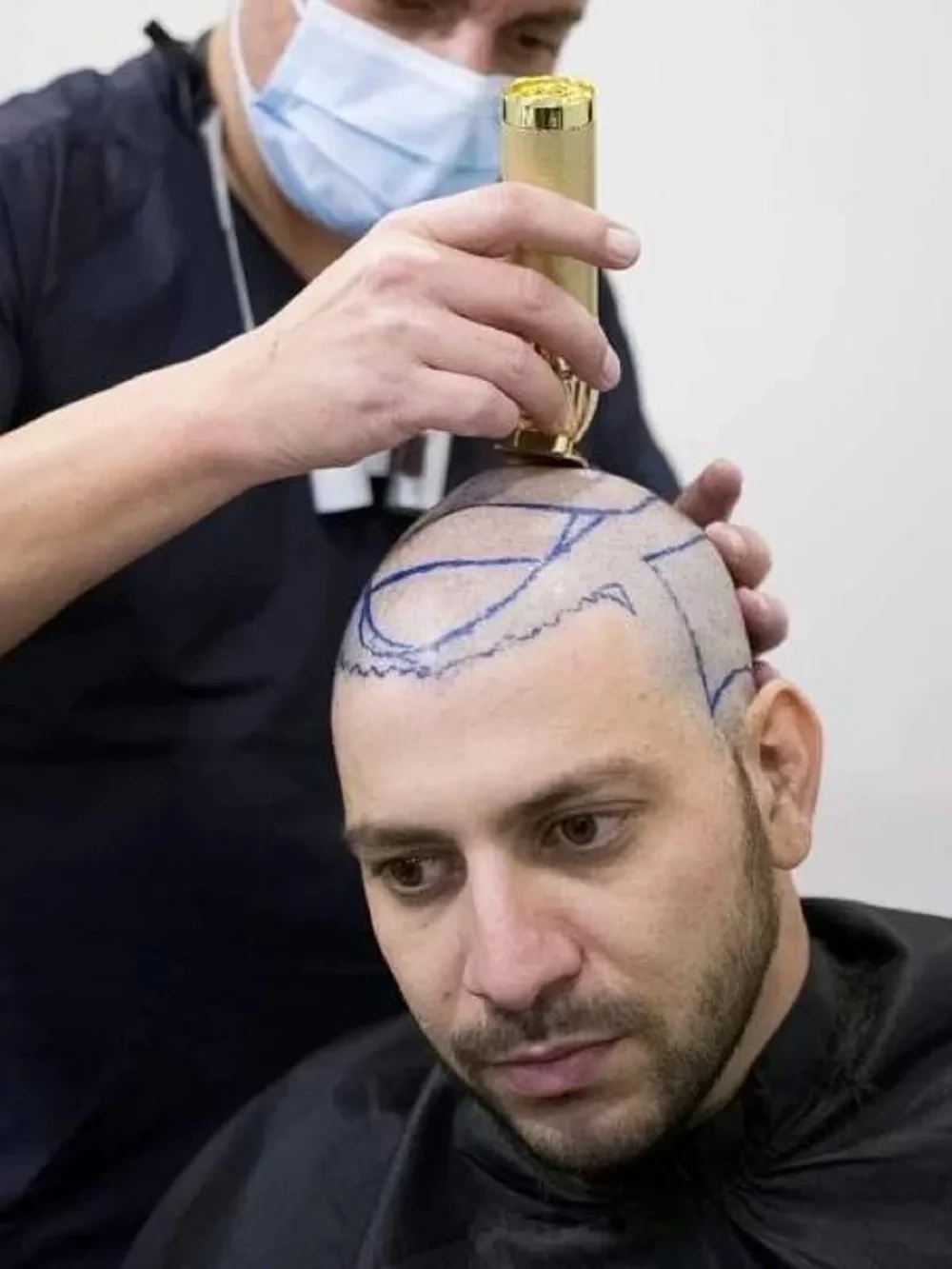 Saiba 10 famosos que fizeram implante de cabelo e se surpreenda - imagem 102071