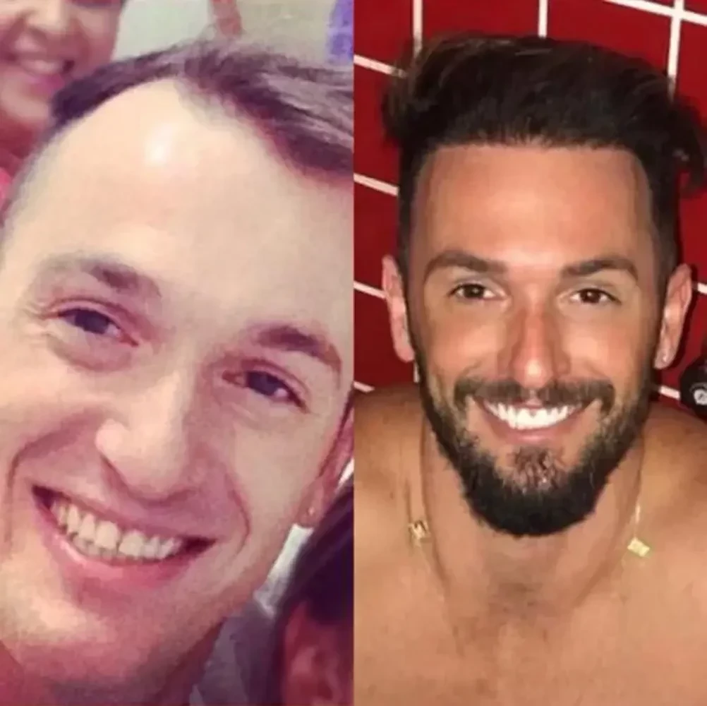 Saiba 10 famosos que fizeram implante de cabelo e se surpreenda - imagem 102072