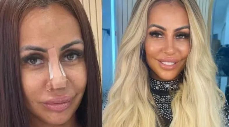 Influenciadora refaz harmonização após conselhos do ChatGPT: “Mais eficaz que com uma pessoa”