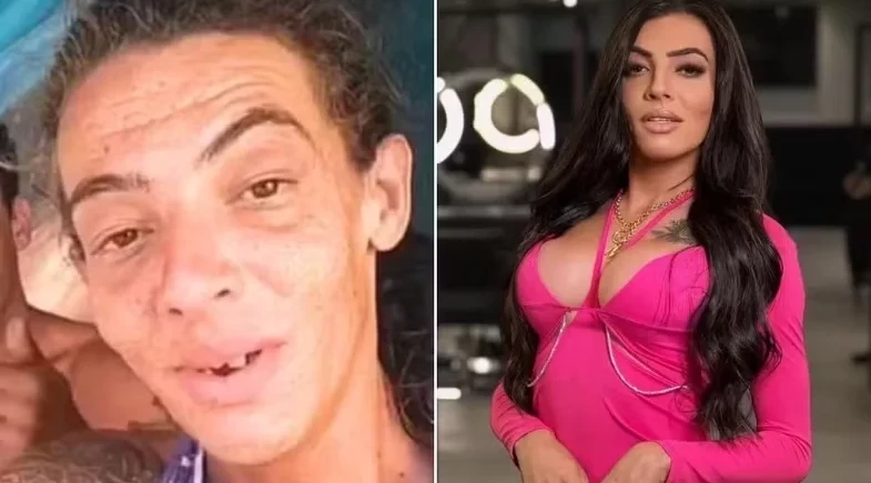 Influenciadora que viveu nas ruas faz 10ª cirurgia estética e surpreende com transformação