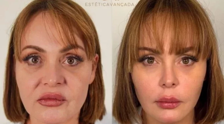 Gaby Spanic faz rejuvenescimento facial e mostra resultado; veja o antes e depois!