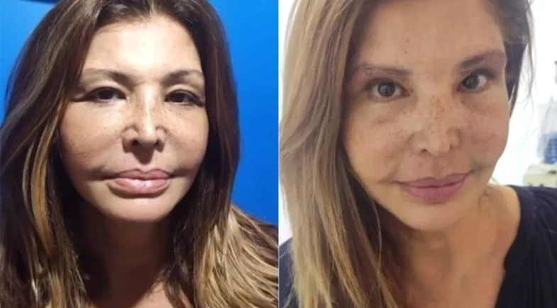 Aos 60 anos, Roberta Close aposta na harmonização facial: veja antes e depois