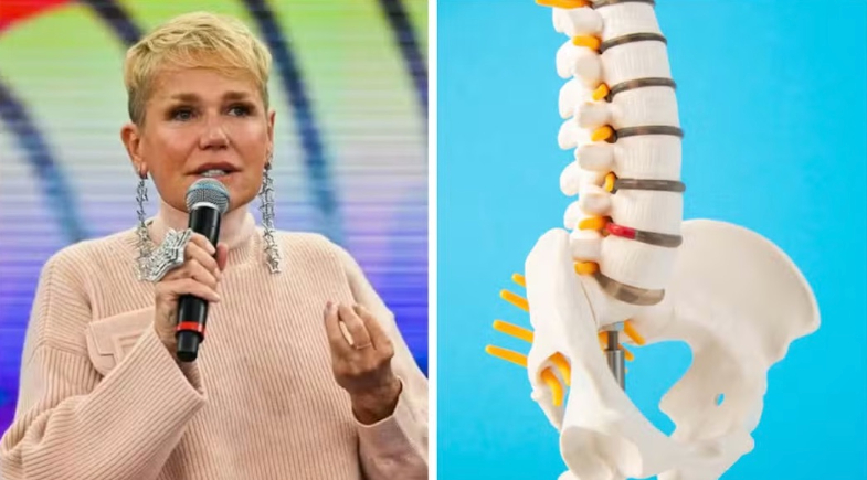 Cirurgia de Xuxa expõe problema comum: o que é estenose de canal e como se proteger