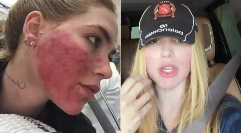 Virginia diz se arrepender de procedimento que deixou rosto em “carne viva”