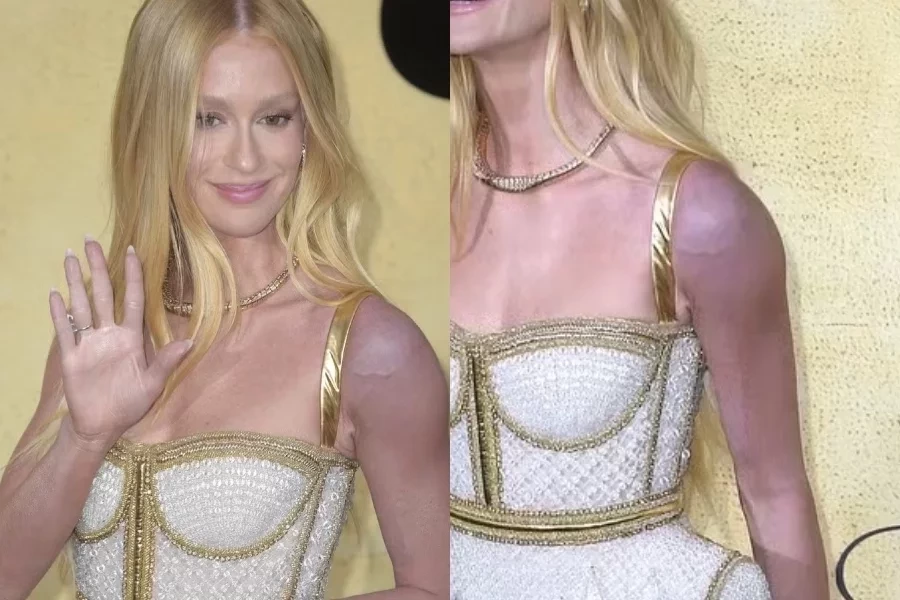 Marina Ruy Barbosa se explica após aparecer com hematomas no braço