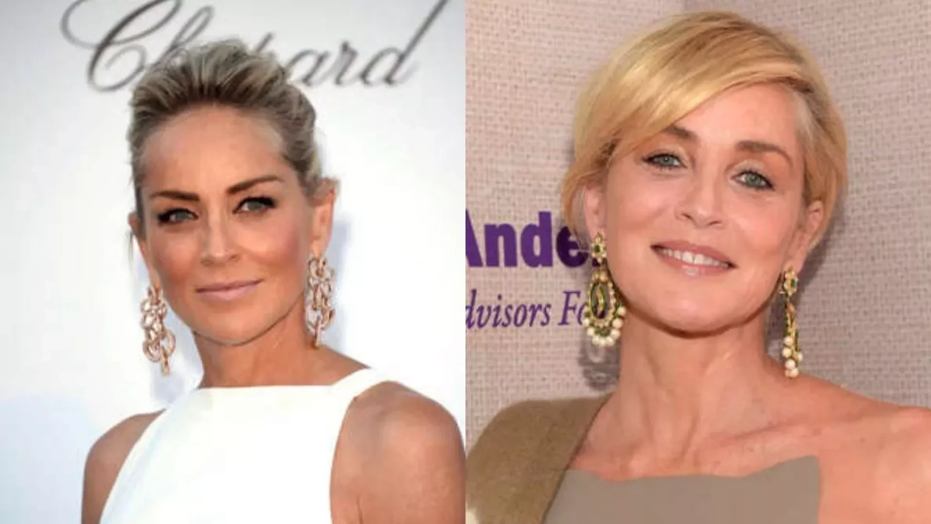 Descubra a história por trás das cicatrizes dos famosos; tem atriz brasileira na lista! - imagem 130806