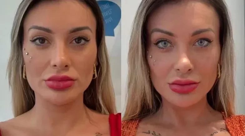 Andressa Urach passa por cirurgia na França e muda definitivamente a cor dos olhos