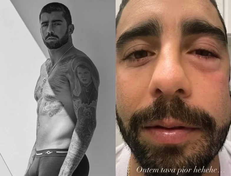 Pedro Scooby tranquiliza fãs após surgir com o rosto deformado: “Ficou inchadão”