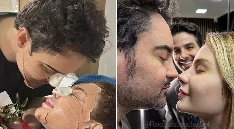 Fernando Zor e Lara Bissi terminam namoro após fazerem rinoplastia juntos