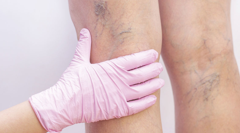 Prefeitura de Parnaíba promoverá Mutirão de Cirurgia Vascular  para a população