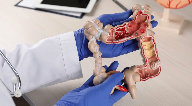 Câncer de intestino: veja quais alimentos podem aumentar o risco da doença