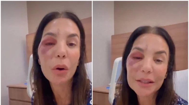 Ivete Sangalo se pronuncia após passar por cirurgia no rosto: “Quebrei dois ossos”