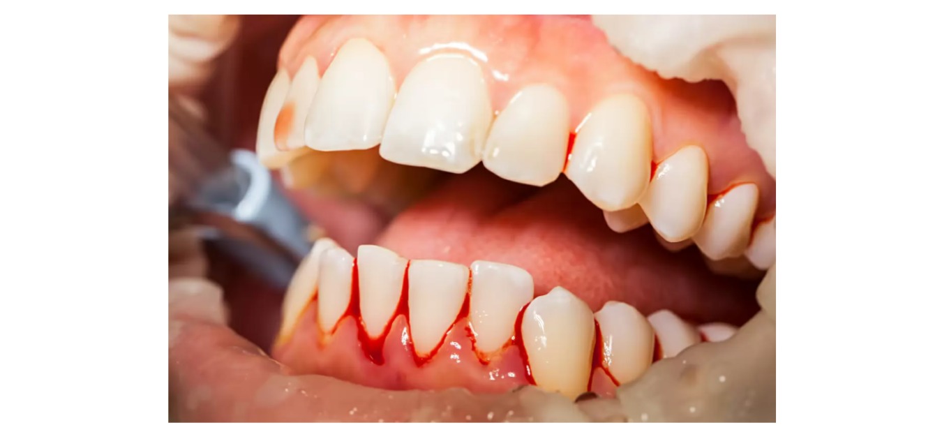 Sinais na boca podem indicar risco de câncer colorretal; veja quais são