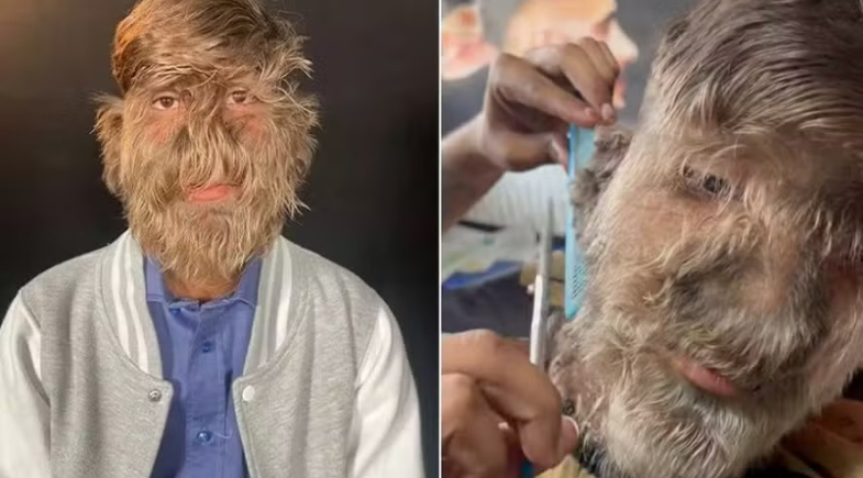 'Síndrome de lobisomem': jovem com o rosto mais peludo do mundo divulga rotina; fotos