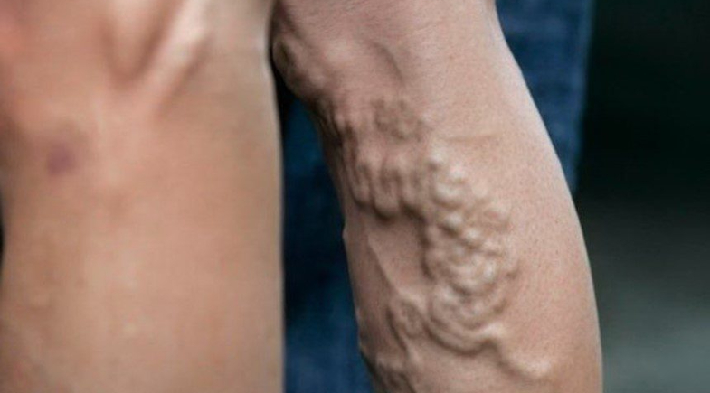 Cãibra na perna à noite? Saiba por que acontece e como aliviar as contrações