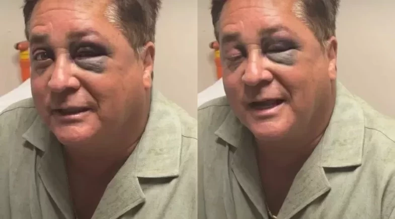 Leonardo surge com hematoma no olho após acidente grave: “Susto”