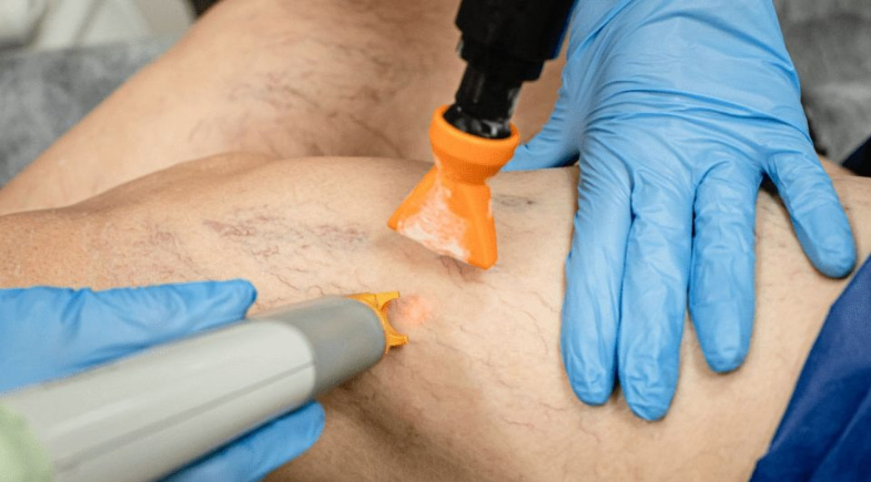 Prefeitura de Luís Correia realiza mutirão para tratamento de varizes no Hospital Municipal