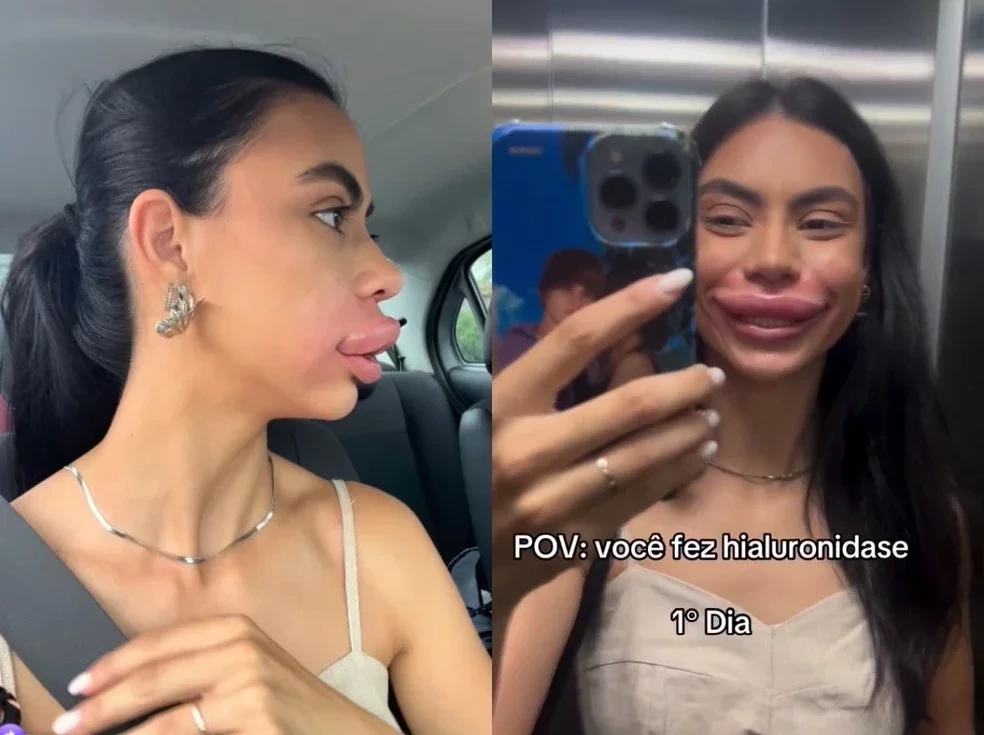 Modelo viraliza ao ficar com inchaço nos lábios após procedimento; fotos