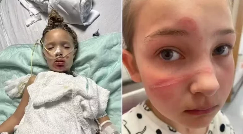 Trend viral com brinquedo que explode deixa crianças gravemente queimadas