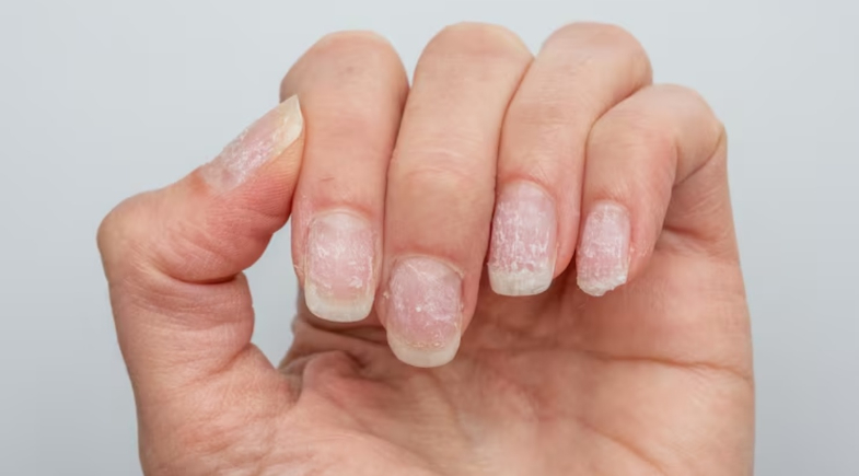 Sua pele e unhas podem revelar falta de vitaminas; veja os sinais de alerta