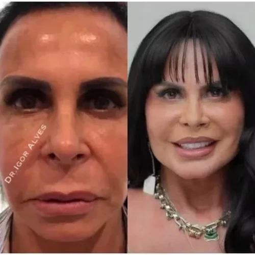 Simone Mendes e outros famosos que mudaram muito após procedimentos estéticos - imagem 151151