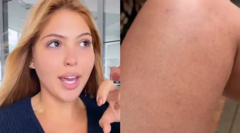 Mariana Menezes revela diagnóstico de urticária crônica espontânea; saiba o que é
